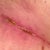 Post Op 35 right groin scar - finally seems to be drying up