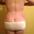 Post Op 34 back view