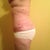 Post Op 34 left side view