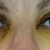 Day 6 - right eyelid feels more swollen
