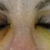 Day 6 - reduced bruising on eyelids. Stitches now removed.
