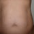 Pre-surgery. 5'4", 125 lbs and fit but just look at that gut!!