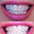 The top photo is day one of the ceramic braces.  The bottom photo is day 15.  So this closes my Invisalign review.  Please read my Ceramic Braces review posted this week:)