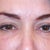 This is immediately after the injection of 1cc syringe of Perlane used on both tear through, and 
cheek.  They are that good at Oasis.