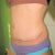 4vmonths post op_no big difference from 10 wks