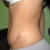 side view. 10 weeks post op