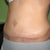10 weeks after my tummy tuck