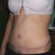 6 weeks after my tummy tuck