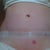 Post-op day 8, TUBE OUT (woo hoo) and scar healing/fading nicely