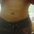 Liposuction Abdomen I Before and After.
