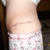 23 days post op