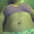 14 days post op