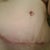 5 weeks po scar.