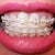 Approx 5 wks photo before visit for adjustment is tomorrow.  Got braces 11/7/12 follow-up 12/12/12.  I see no movement to left and right.  I feel like they are the same or more bunched.