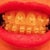 5wk before adjustment bad photo color.  This bunched up look is my major complaint.  It looks like the braces are making it worse!  Up close they still look like this.  It's horrific to me.