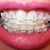 5th wk before adjustment:  Pull my neighboring teeth to the left and right a lot, till the front ones sit inside, not on the other teeth.  It's making me crazy.