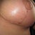 Left Breast. Scars are healing nicely : )