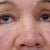 Fresh after fillers