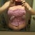 the day after surgery. I will take a picture without the compression garment on when i am cleared for showering...