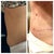 6 mos post op tt and just had touch up lipo done