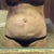 2 days post op smart/vibro lipo