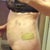 2 days post op smart/vibro lipo