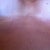 My incisions POST-OP 1 Month