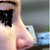 Profile - 17 days post op