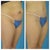6 weeks PS b4 & after pics. I was quite swollen, being patient for final result!