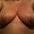 1 wk post op - I have two diamonds!