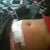 2 days after TT