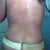 1 month post op starting the new gel silocone tape