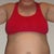 Before (day of surgery)