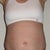 After (day 10 post-op)