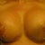 Post-op 15 days, steri-stips off, right one has some superficial scabing and left one still swollen, all in all they look prety good at this stage :)