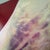 PO Day 10-This is the bruise on my inner thigh from the lipo. The other leg isn't nearly as bad.