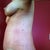 PO Day 10-Side view: Swelling is really evident. The good news is I feel fine.