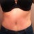 8 1/2 week post op in jeans