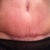 8 1/2 week post op scar