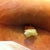 my wound with the packing sticking out