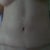 5.5 months post-op