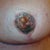 This is a picture of my then dying nipple and areola. The bubbles you see are blistering of the area.