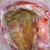 This was taken after dying and rotting fat was removed. She would cut out all of the fat and pack me full of saline soaked gauze. Fat has been removed every week.