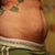 night before TT and scar revision - double butt