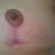 Left breast scar