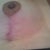 Right breast scar