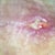 Open area stiches were protruding had to be snipped out so it would heal. Can't re-close it cause of bacteria concerns. Oh well just be a wider part of the scar. Not upset by it, still looking damn good!