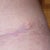 14 weeks 2 days PO.....this is a dog ear although not too clear that it is on here, good white scarring