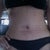 3.5 weeks PostOp.  My undies feel tighter than usual.  With all the bloating I can see a slight difference between my before and after pics. The marks on my stomach are from the compression garment I wear 24/7.
