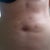2 days after liposonix. The treated area is the stomach from the belly button up